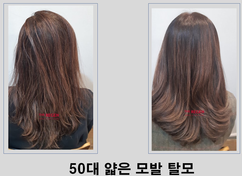 50대 앓은모발 before after